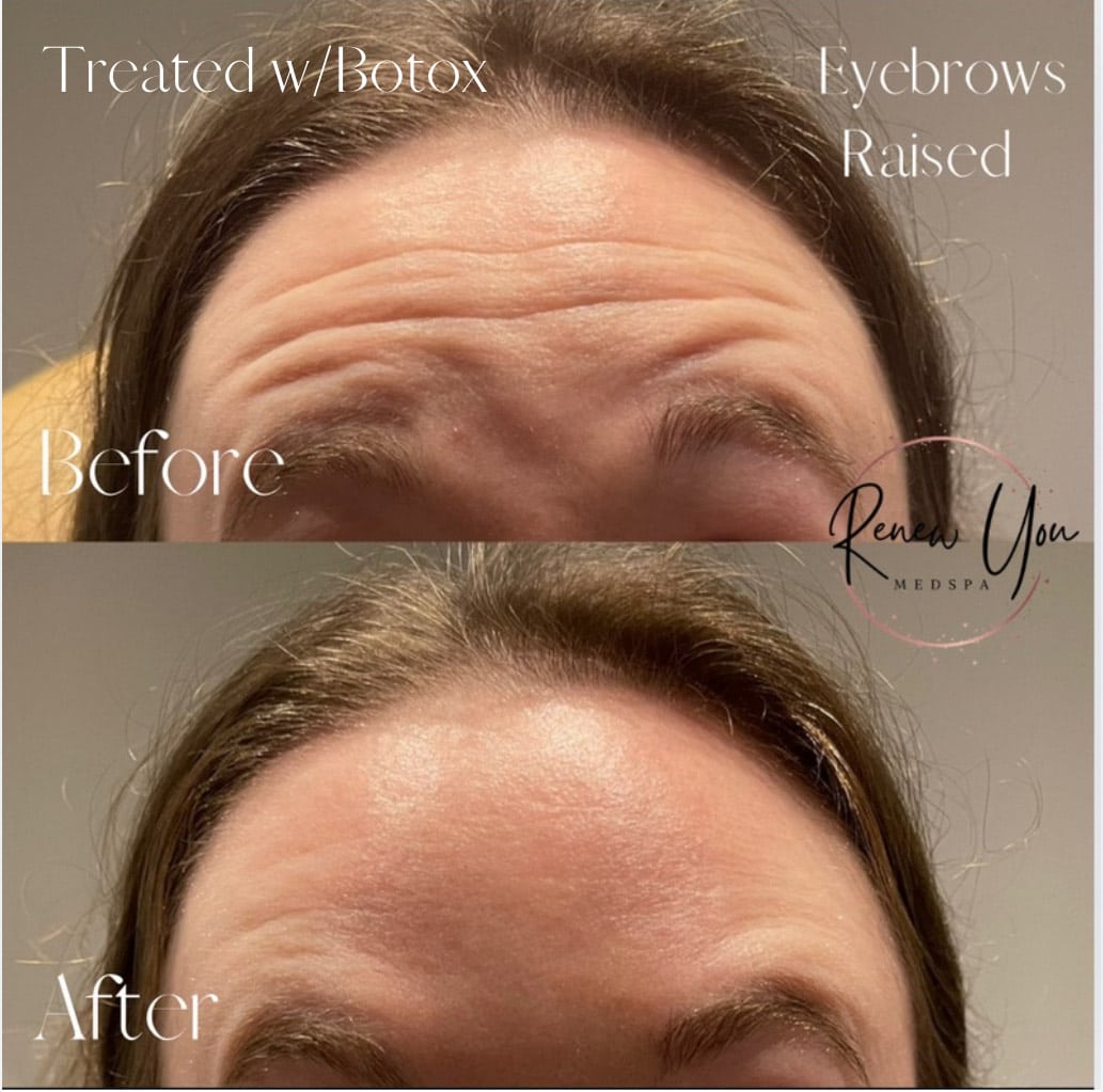 Before and After Image: Botox - front