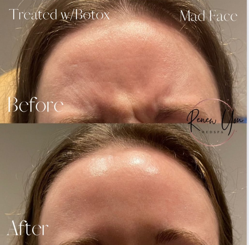 Before and After Image: Botox - front