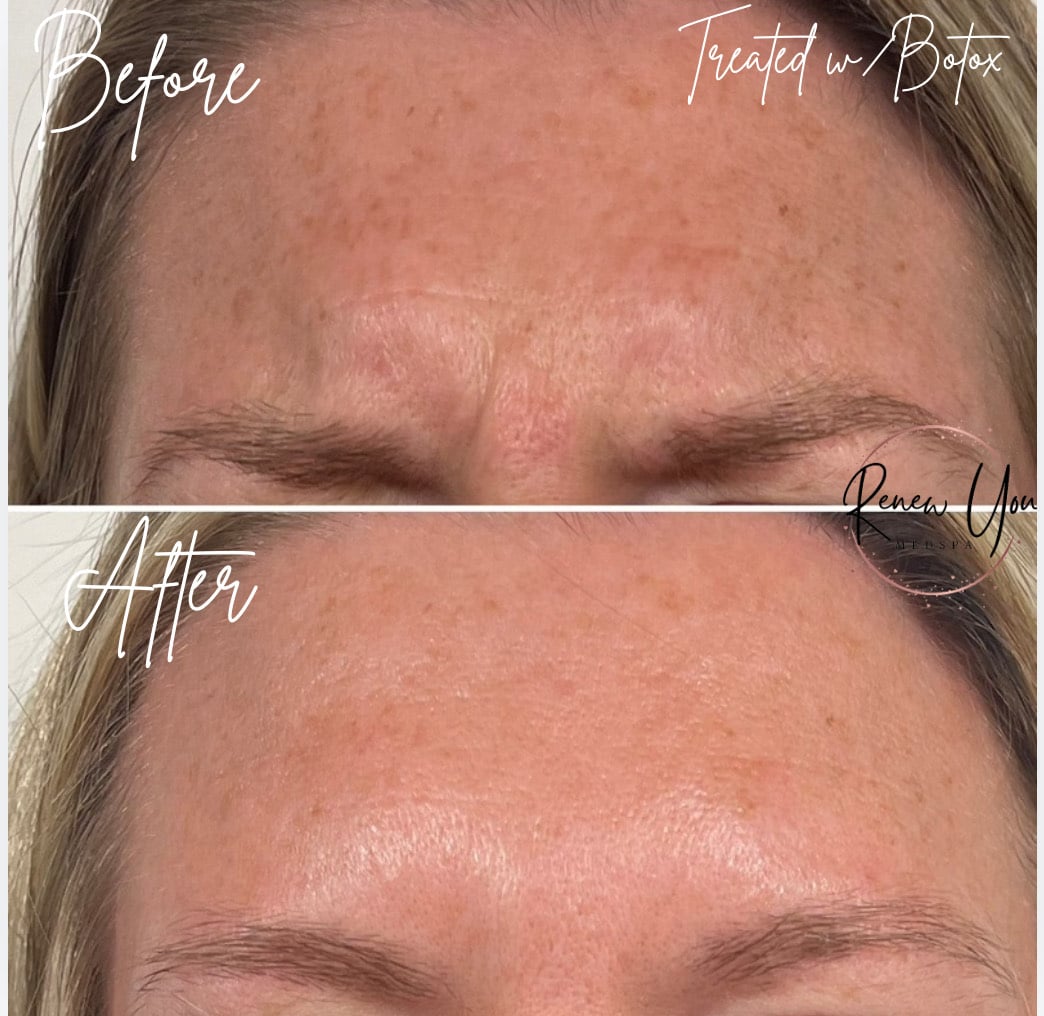 Before and After Image: Botox - front