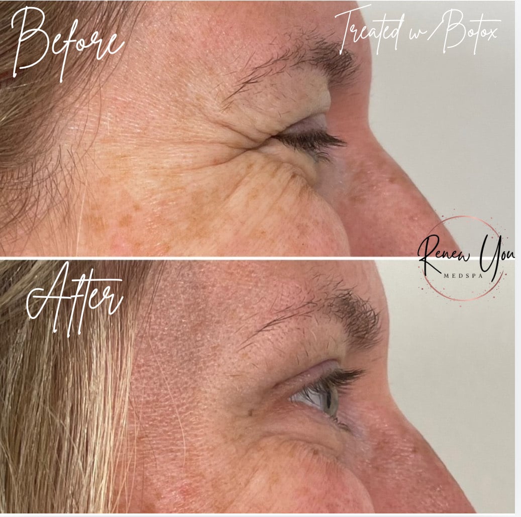 Before and After Image: Botox - right-side
