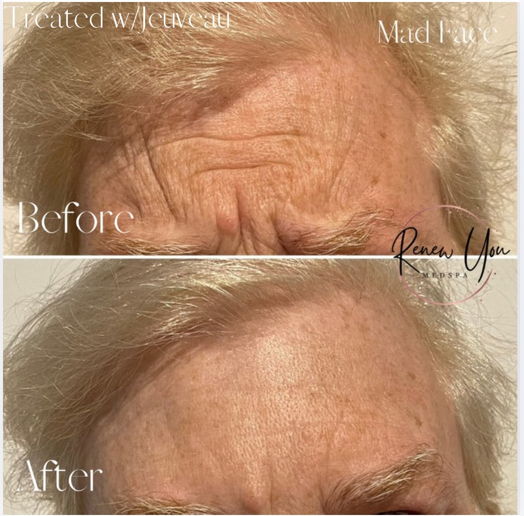 Before and After Image: Jeuveau - front