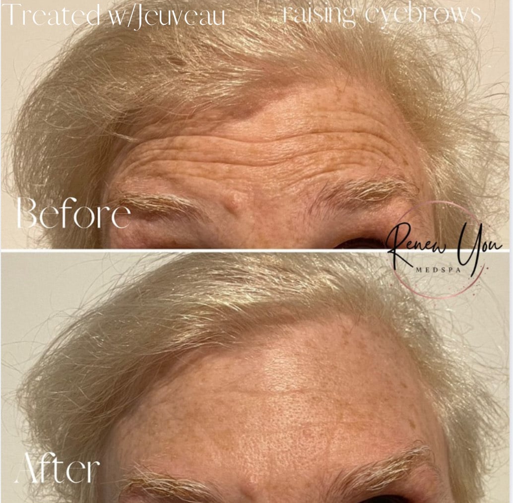 Before and After Image: Jeuveau - front