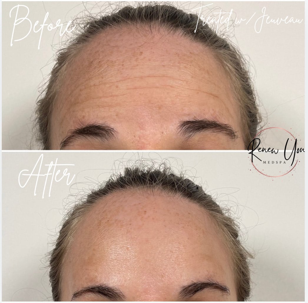 Before and After Image: Jeuveau - front