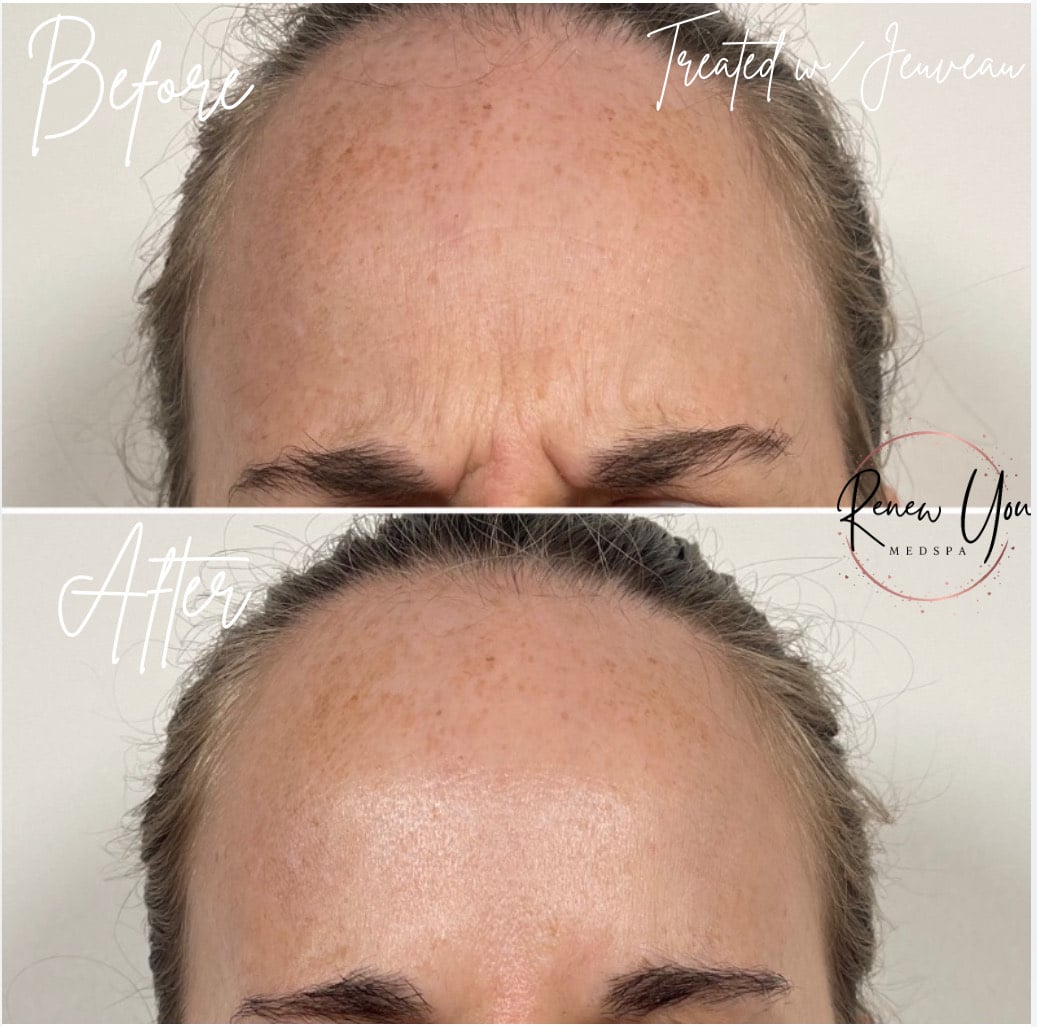 Before and After Image: Jeuveau - front