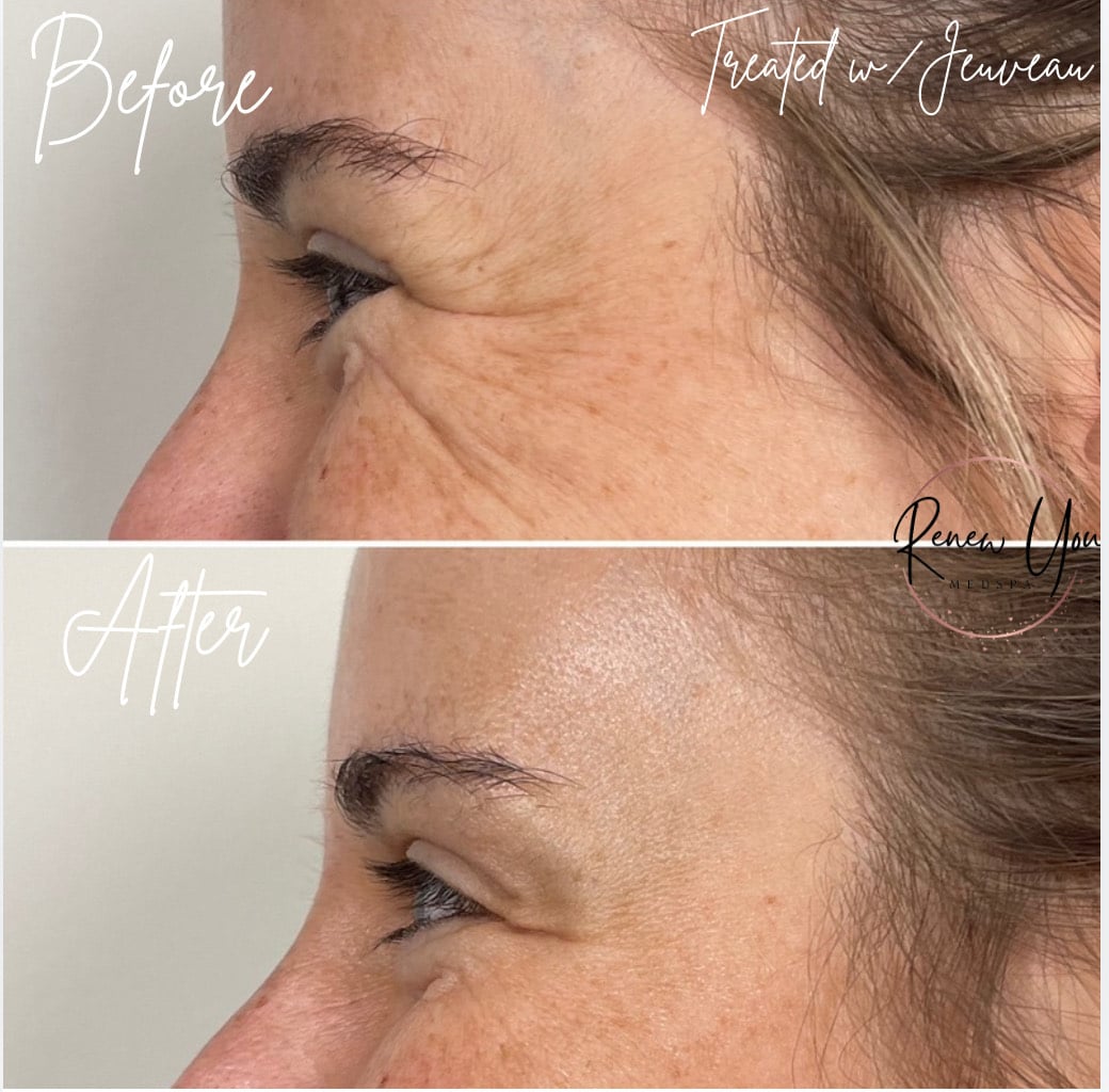 Before and After Image: Jeuveau - left-side