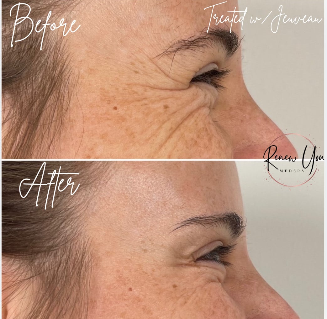 Before and After Image: Jeuveau - right-side