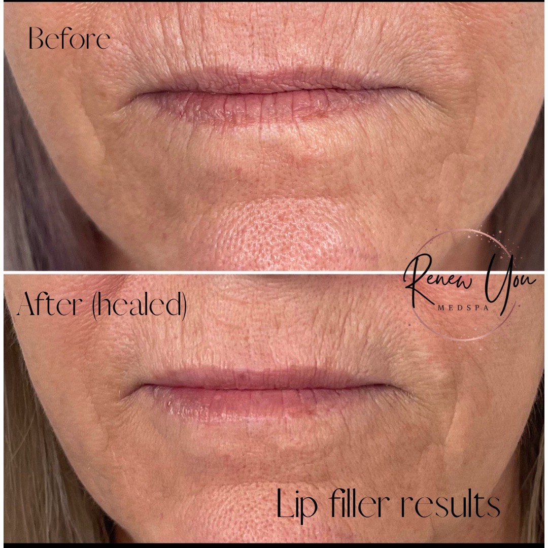 Before and After Image: Lip Filler