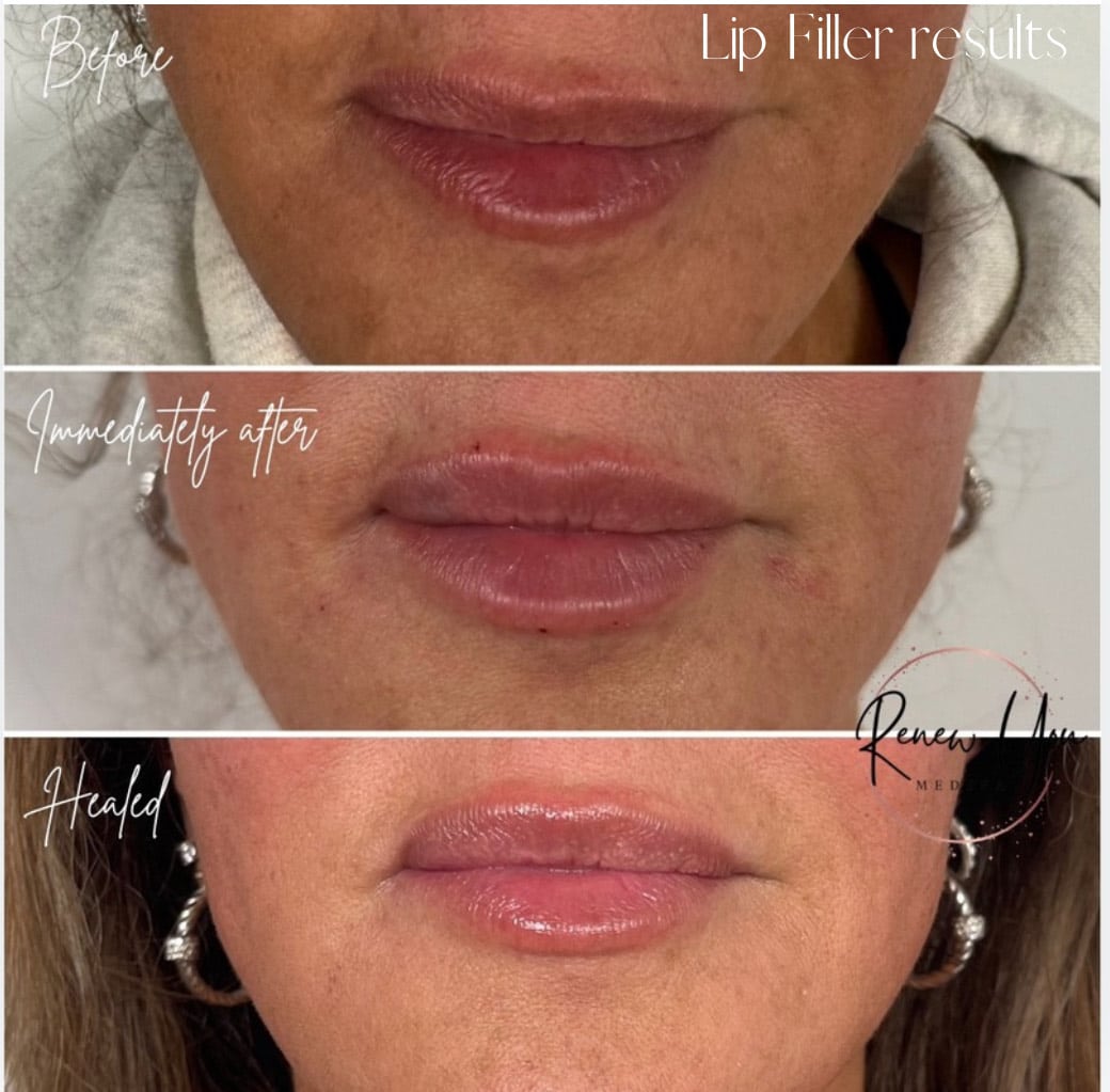 Before and After Image: Lip Filler - front