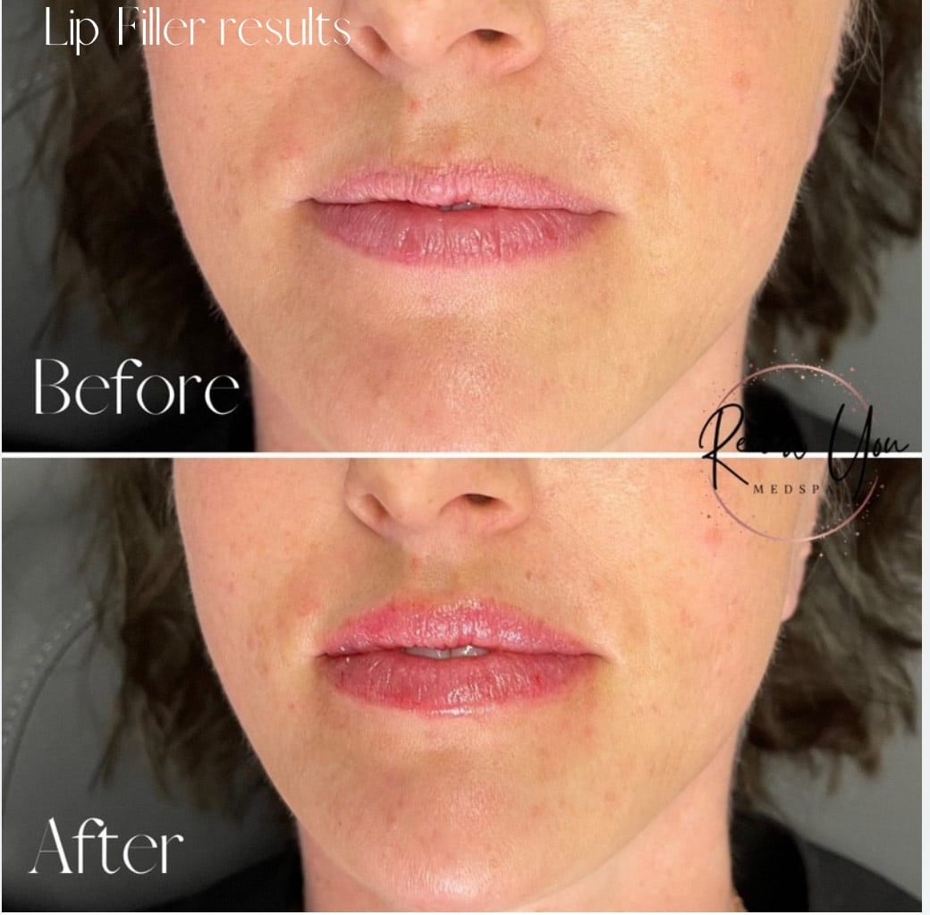 Before and After Image: Lip Filler - front