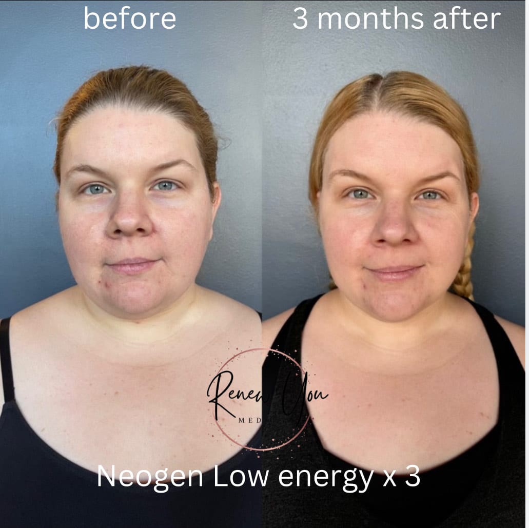 Before and After Image: NeoGen - front
