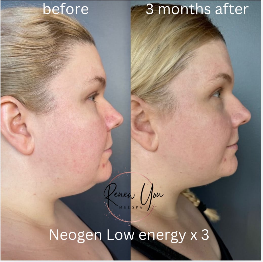Before and After Image: NeoGen - right-side