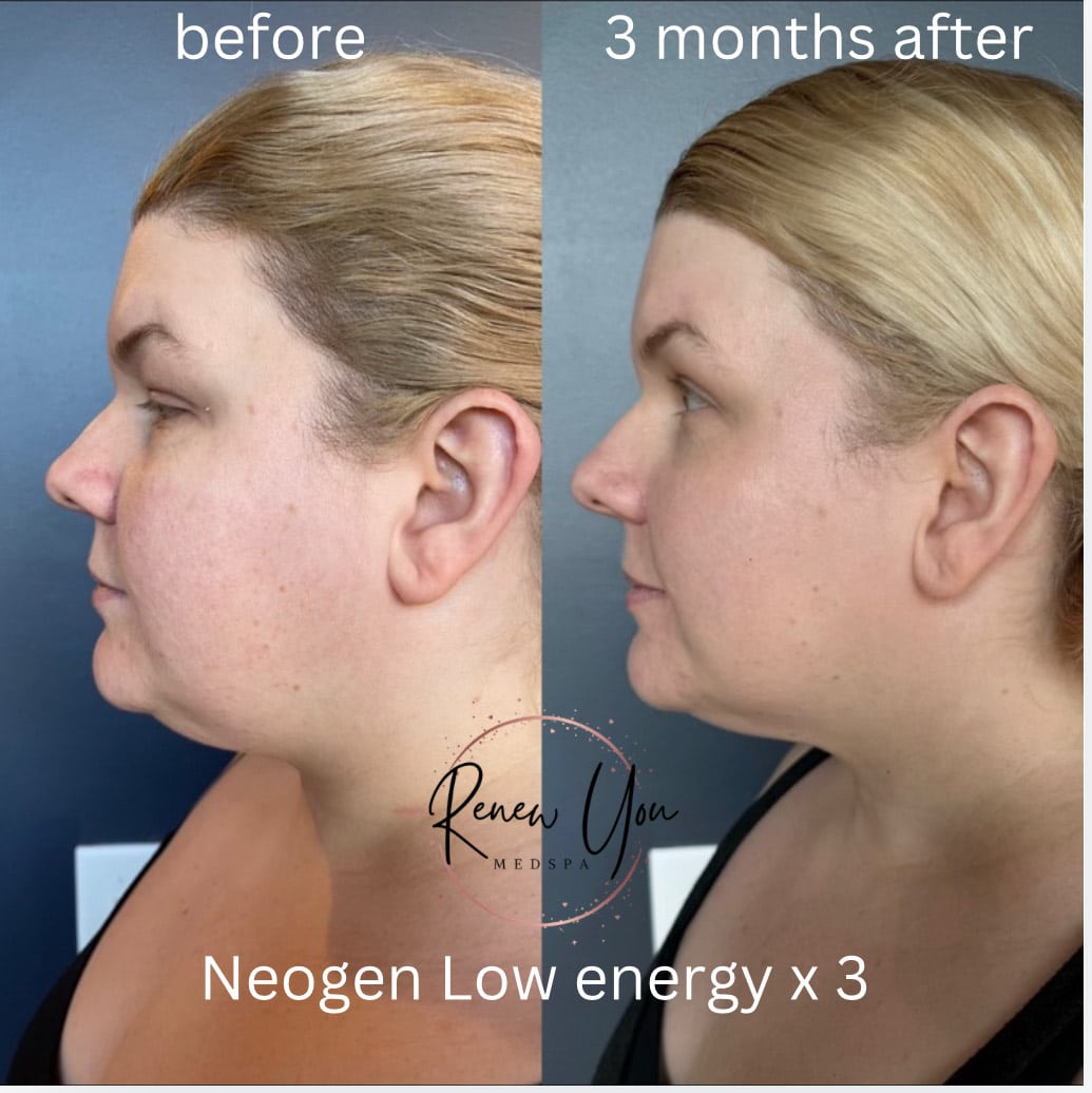 Before and After Image: NeoGen - left-side