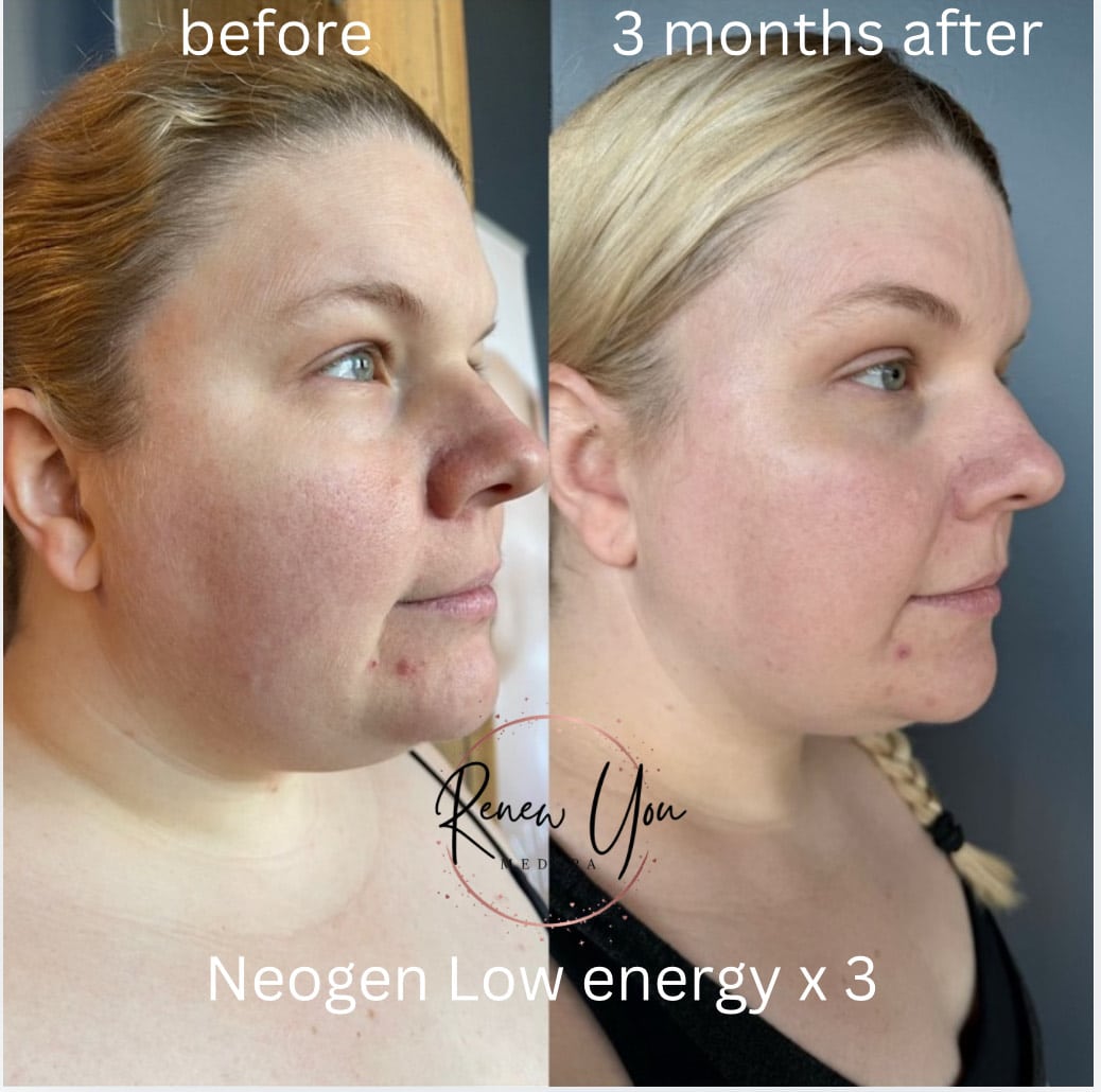 Before and After Image: NeoGen - right-front-oblique