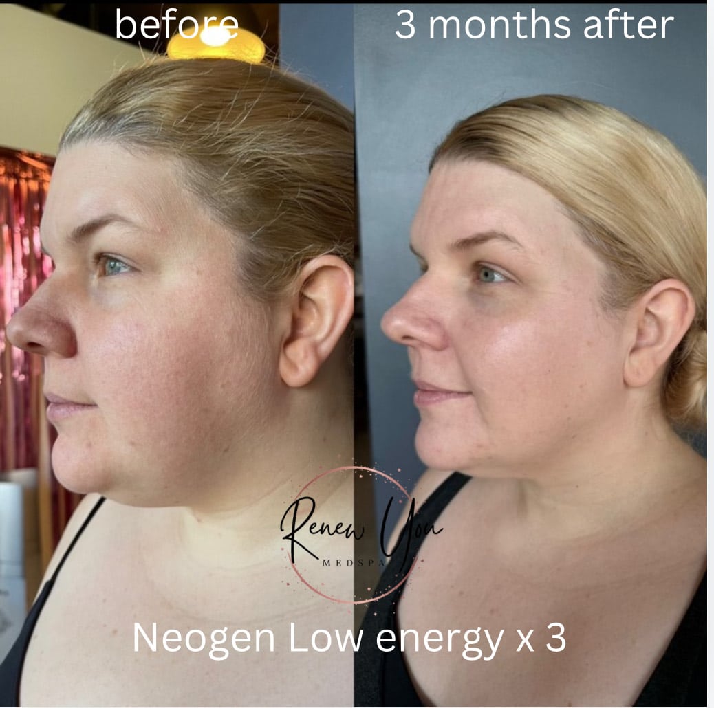 Before and After Image: NeoGen - left-front-oblique