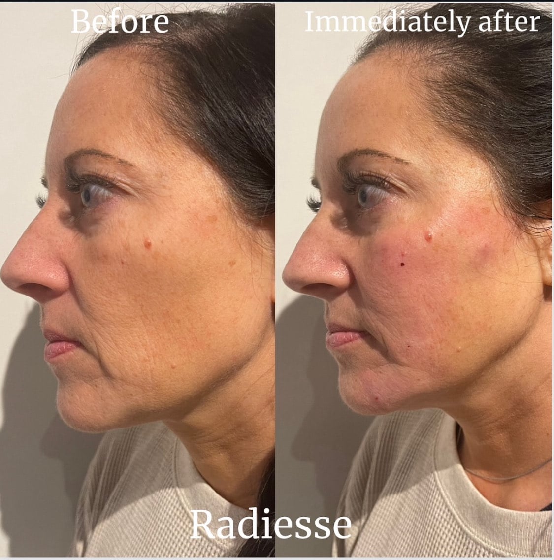 Before and After Image: Radiesse - left-side
