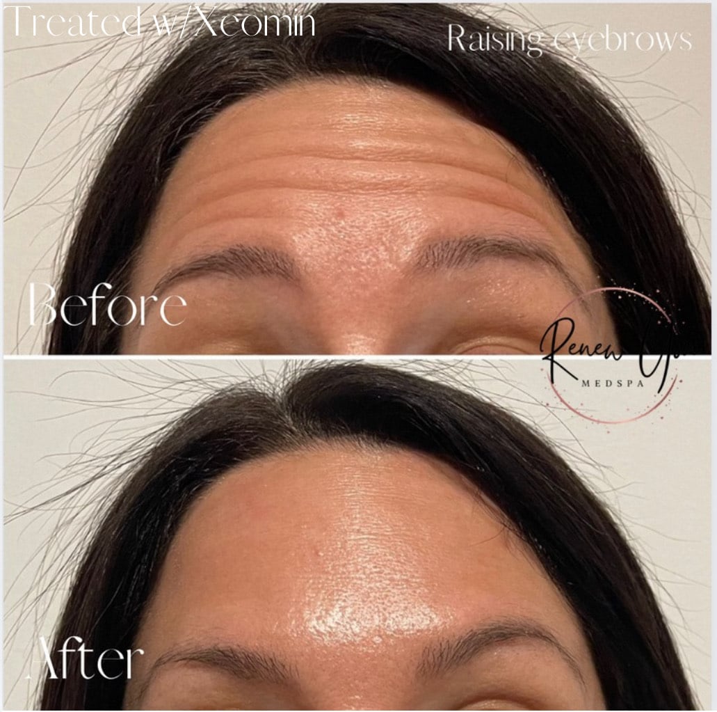 Before and After Image: Xeomin - front