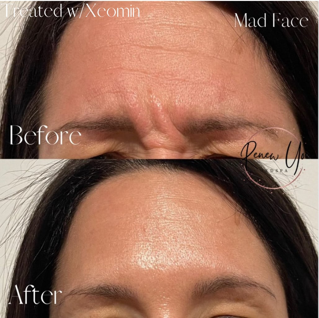 Before and After Image: Xeomin - front