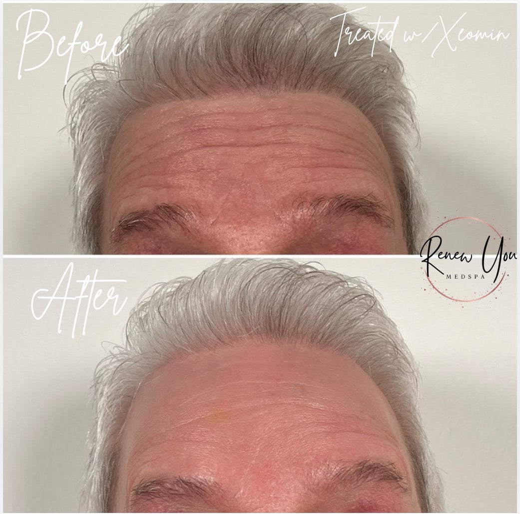 Before and After Image: Xeomin - front