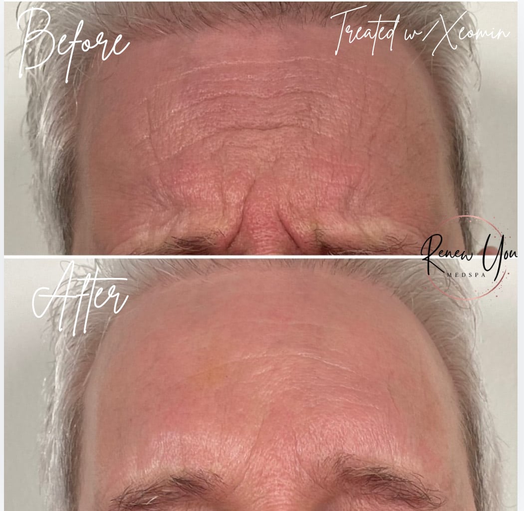 Before and After Image: Xeomin - front