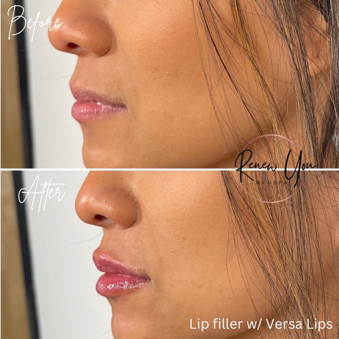 Before and After Image: Lip Filler with Versa Lips