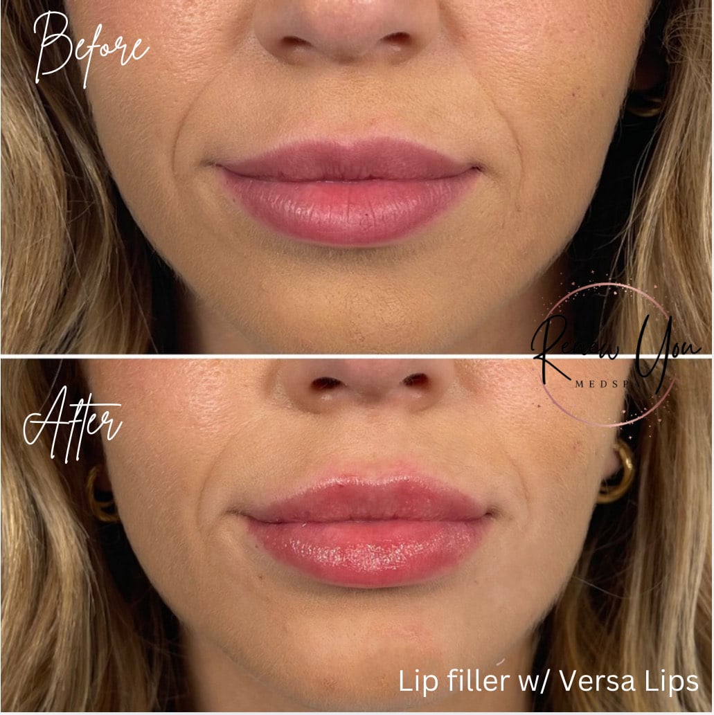 Before and After Image: Lip Filler with Versa Lips