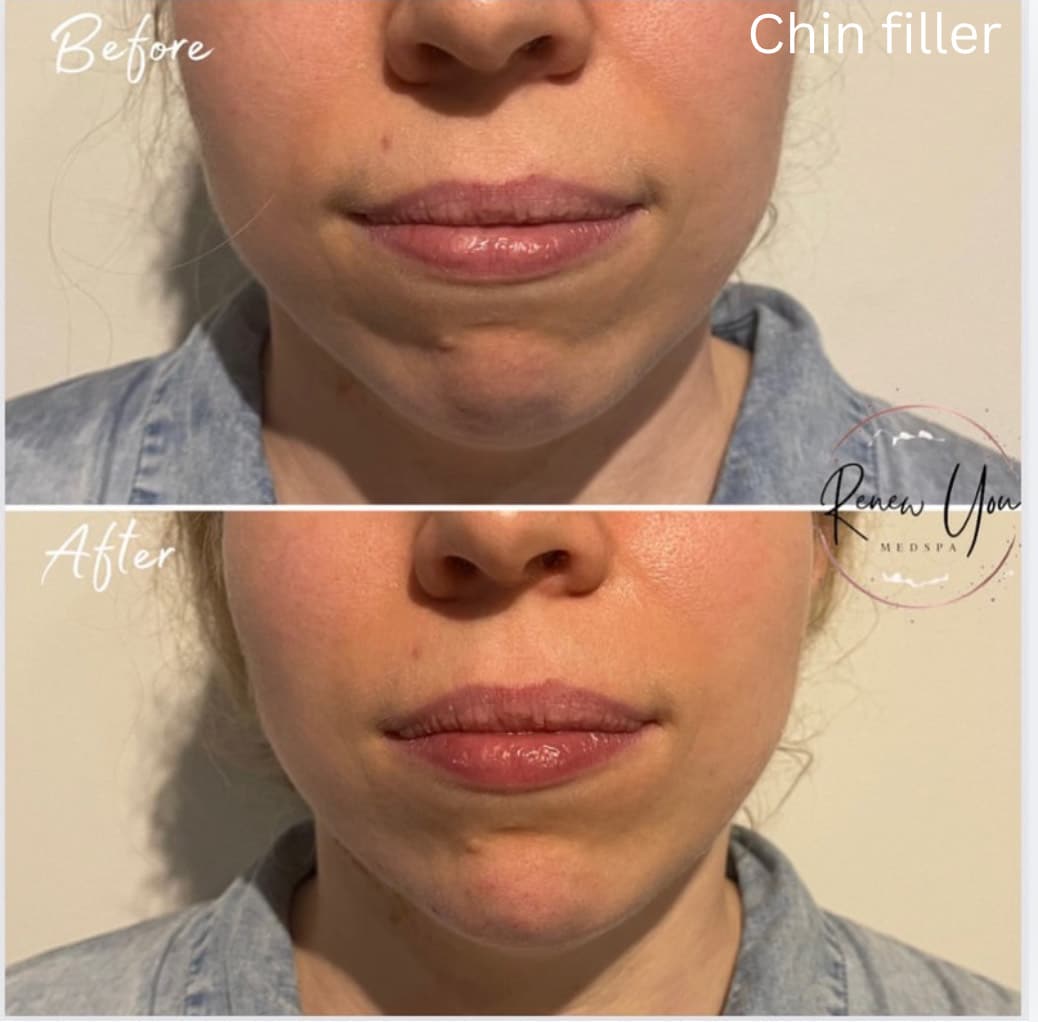 Before and After Image: Chin Filler - front