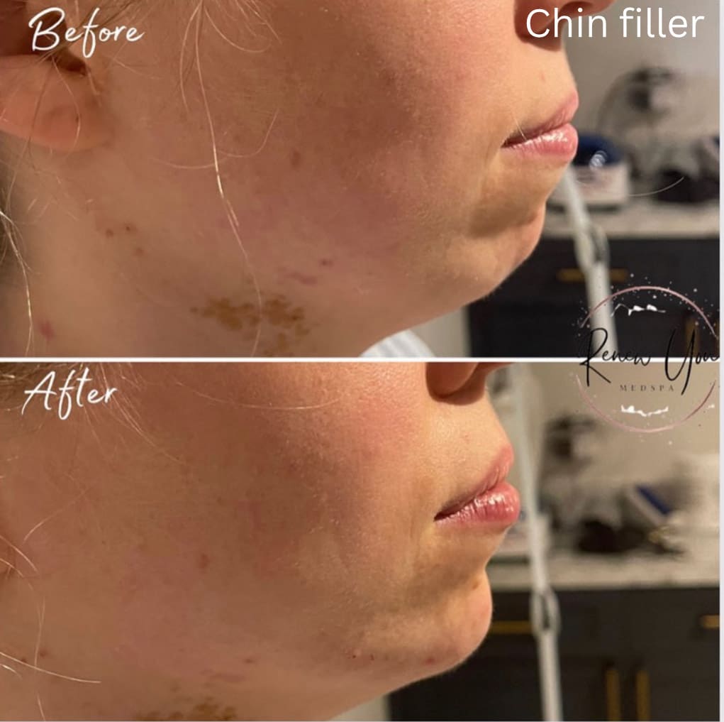 Before and After Image: Chin Filler - right-side