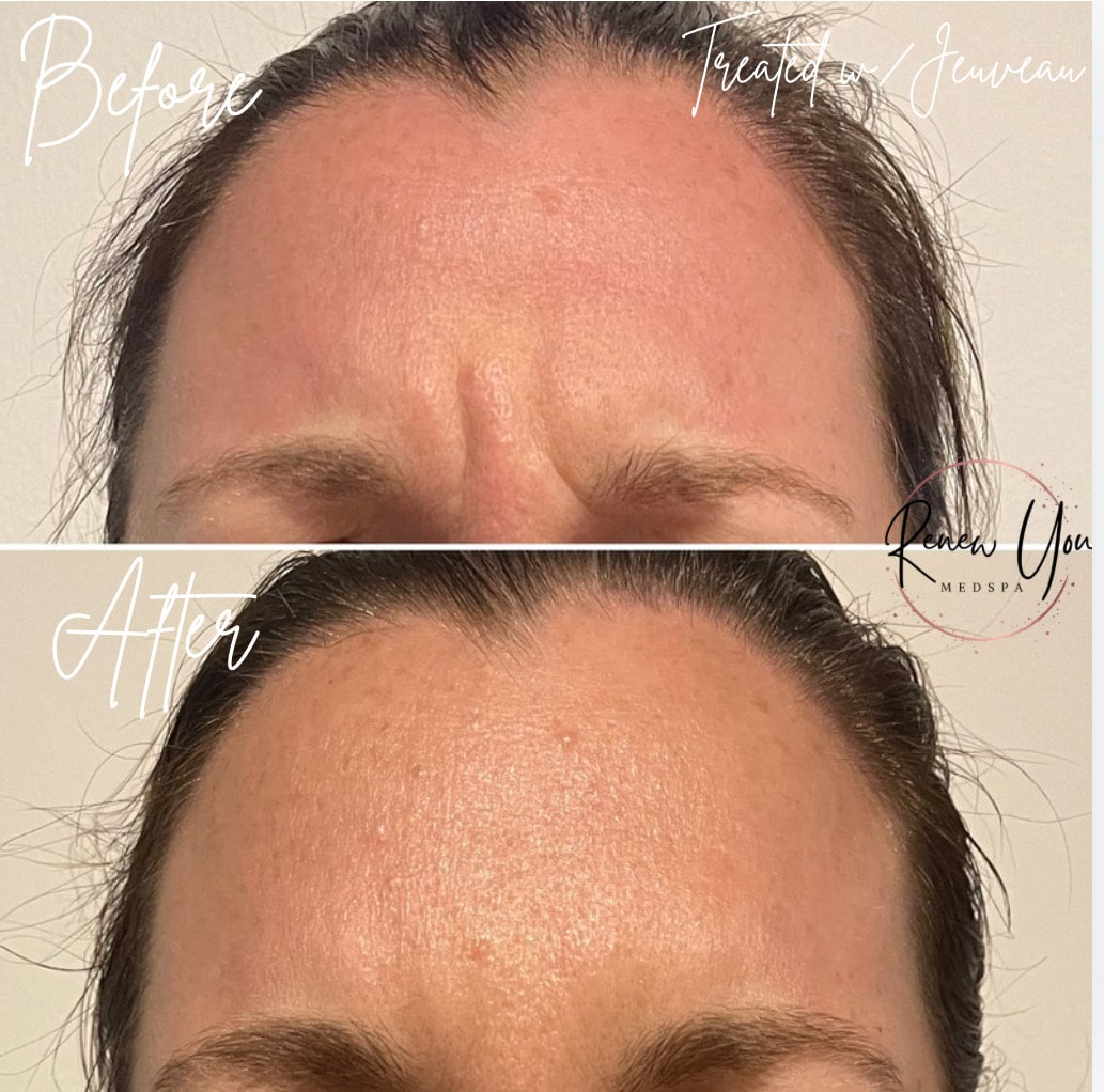 Before and After Image: Jeuveau - front