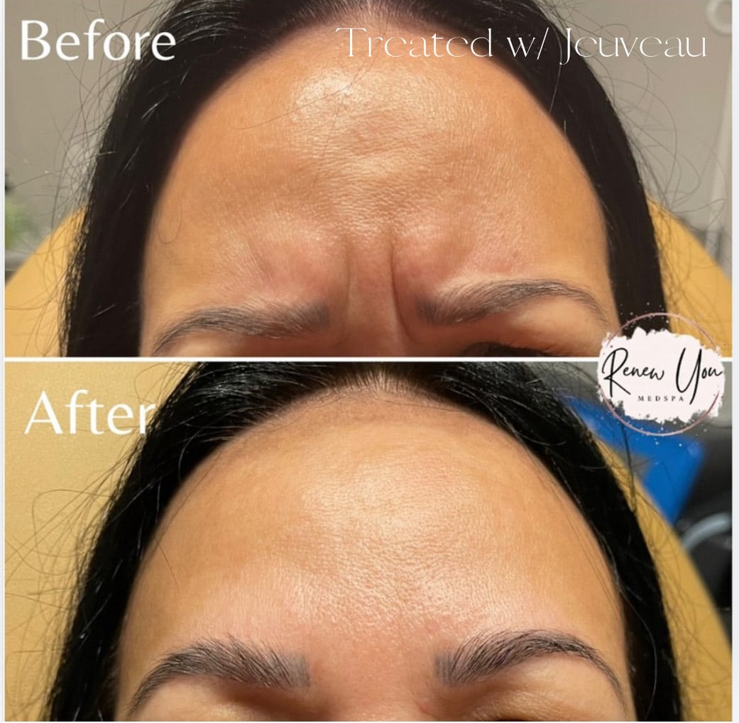 Before and After Image: Jeuveau - front