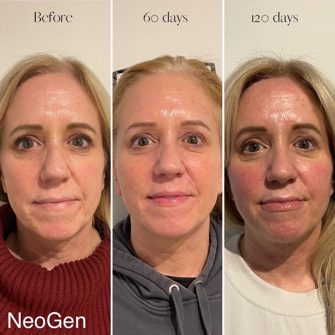 Before and After Image: Neogen - front