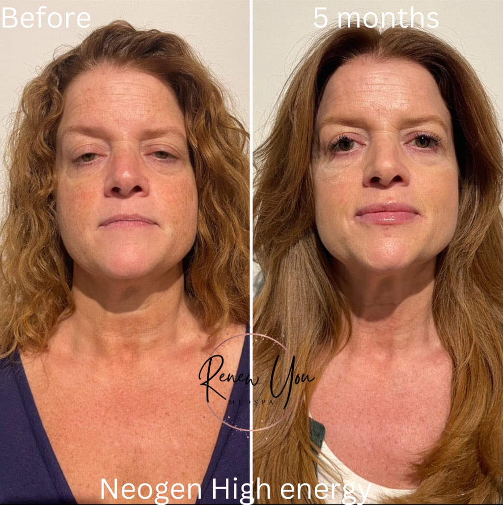 Before and After Image: Neogen - front