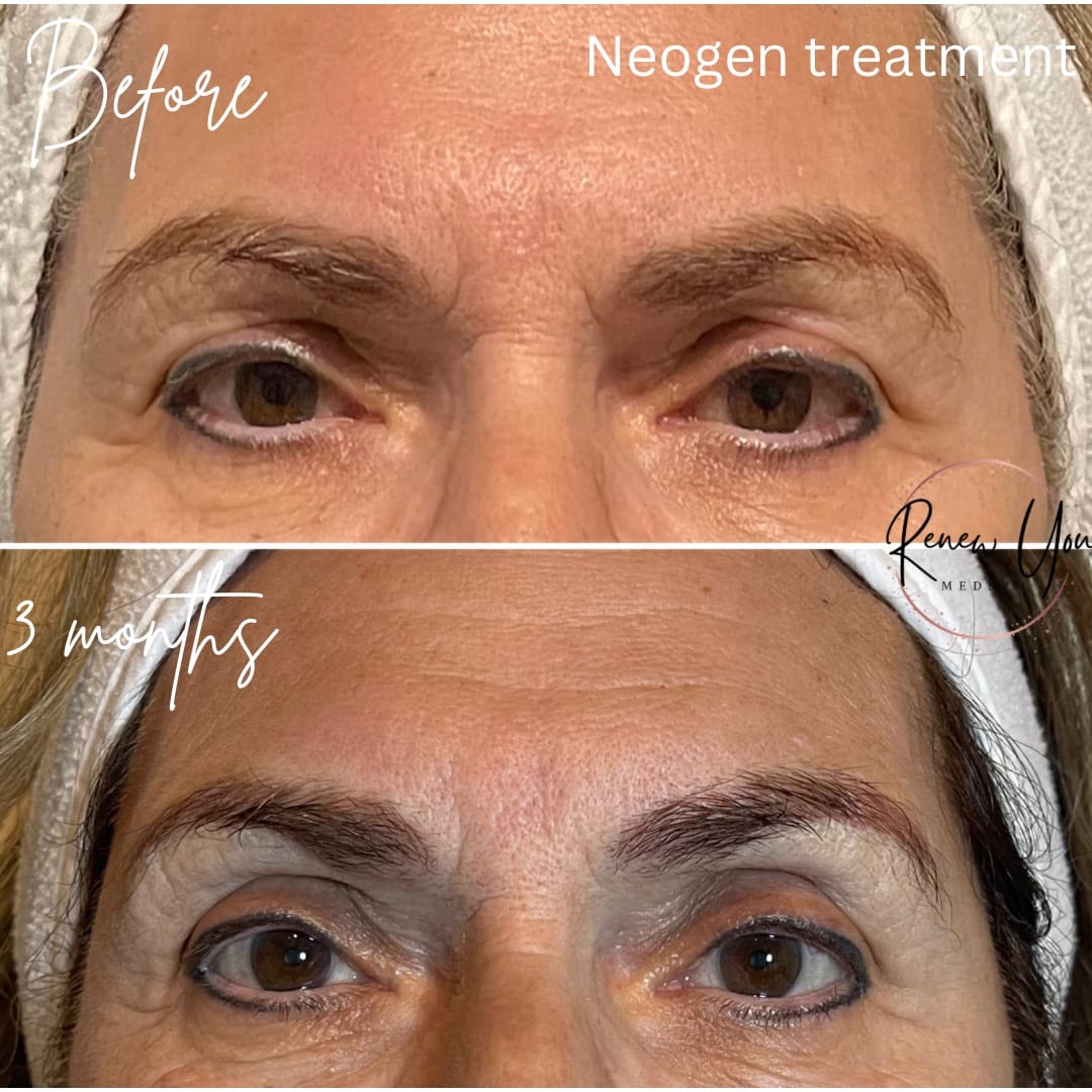 Before and After Image: Neogen - front
