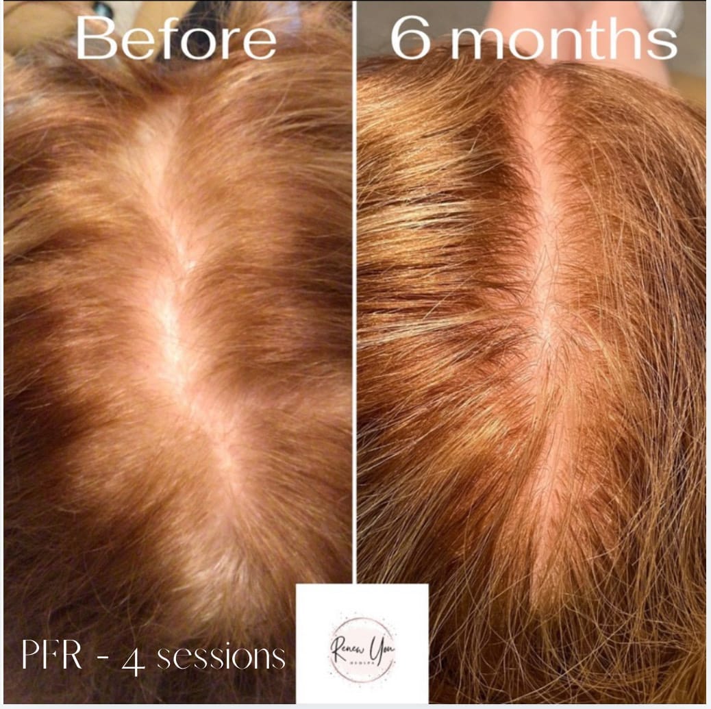 Before and After Image: PFR - front