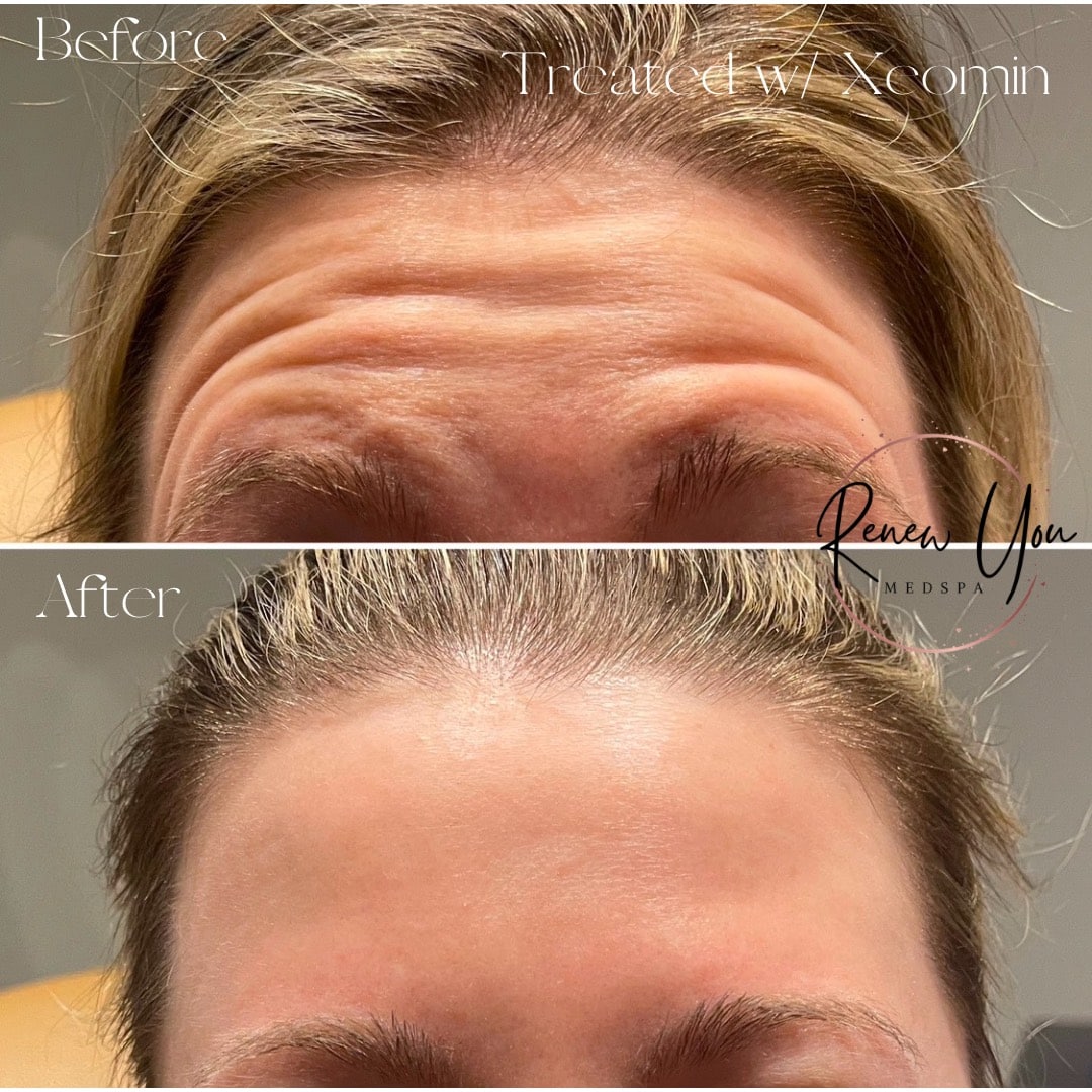 Before and After Image: Xeomin - front