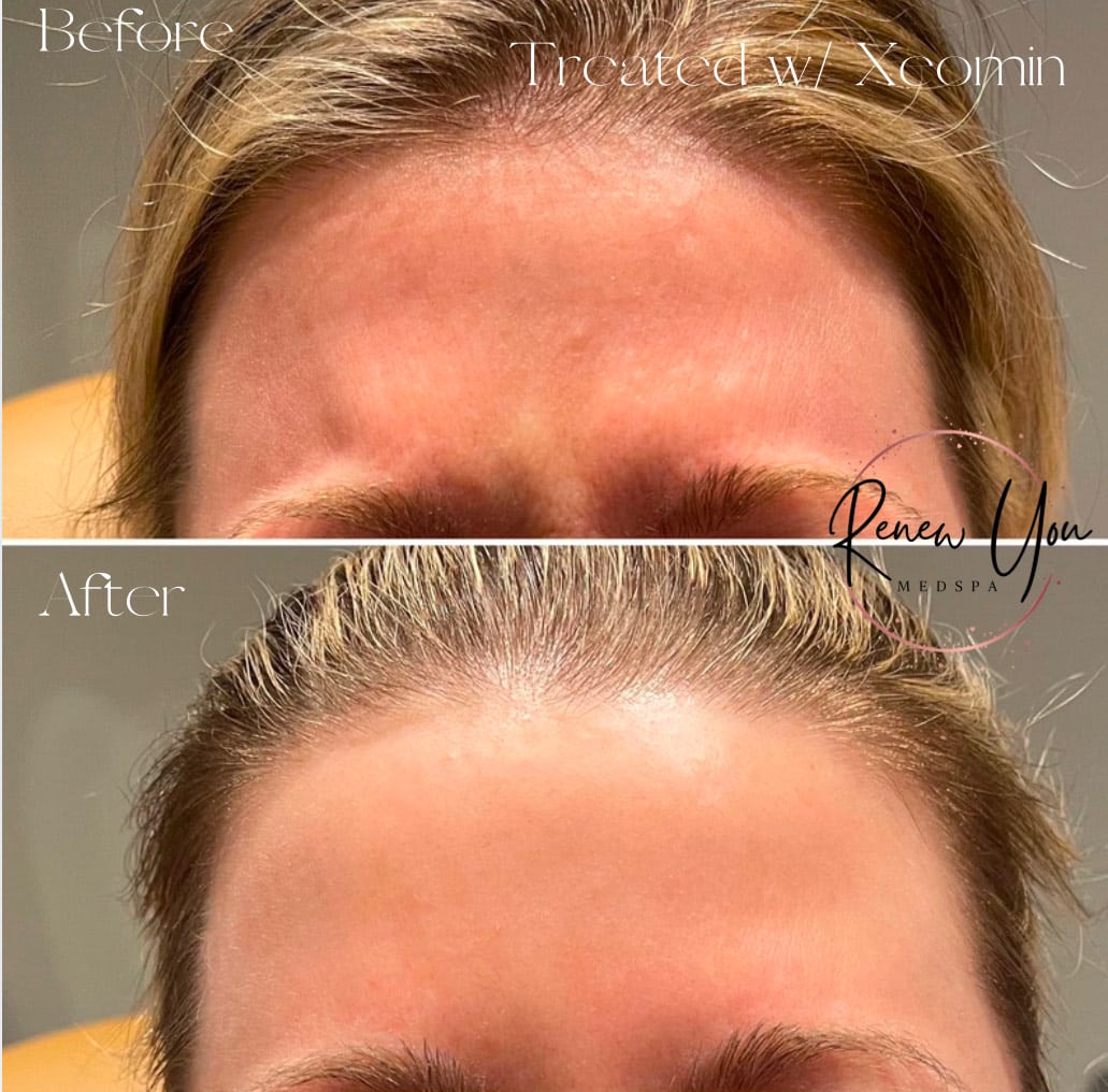 Before and After Image: Xeomin - front