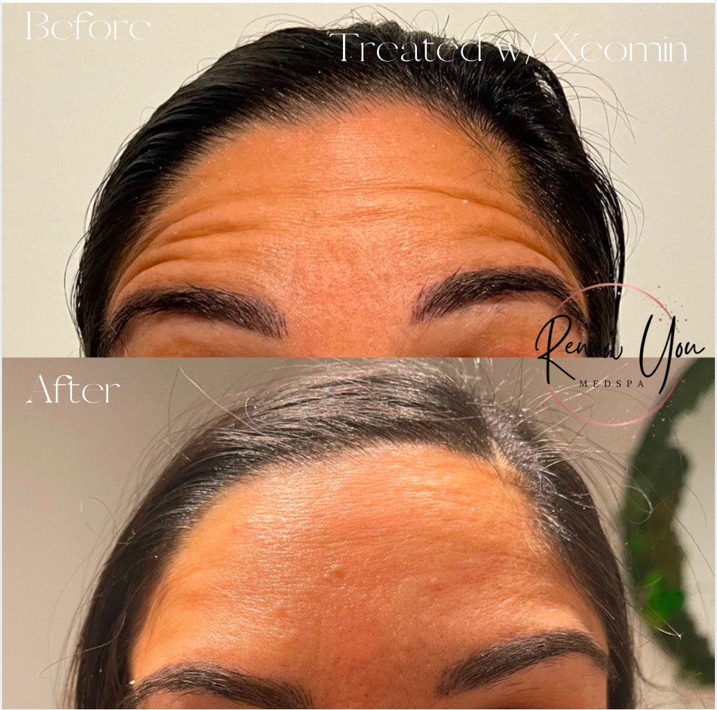 Before and After Image: Xeomin - front