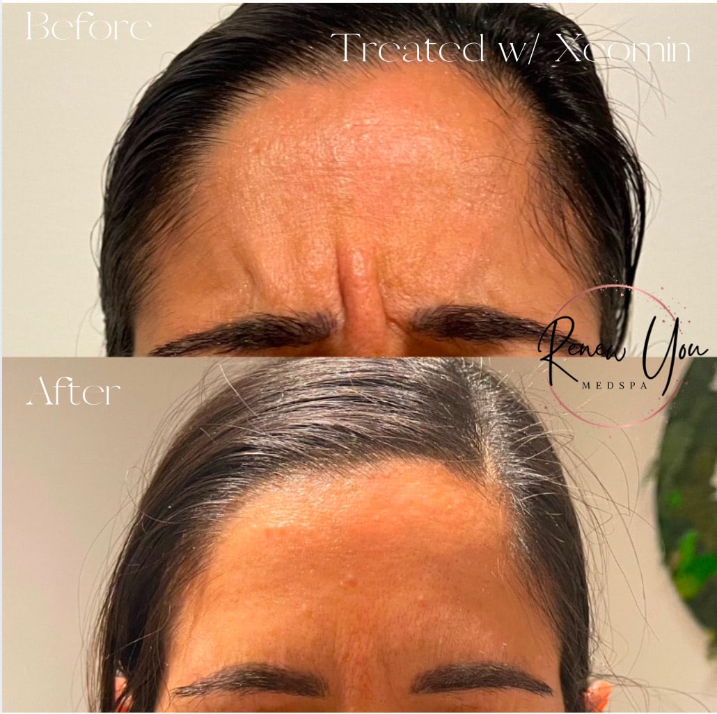 Before and After Image: Xeomin - front