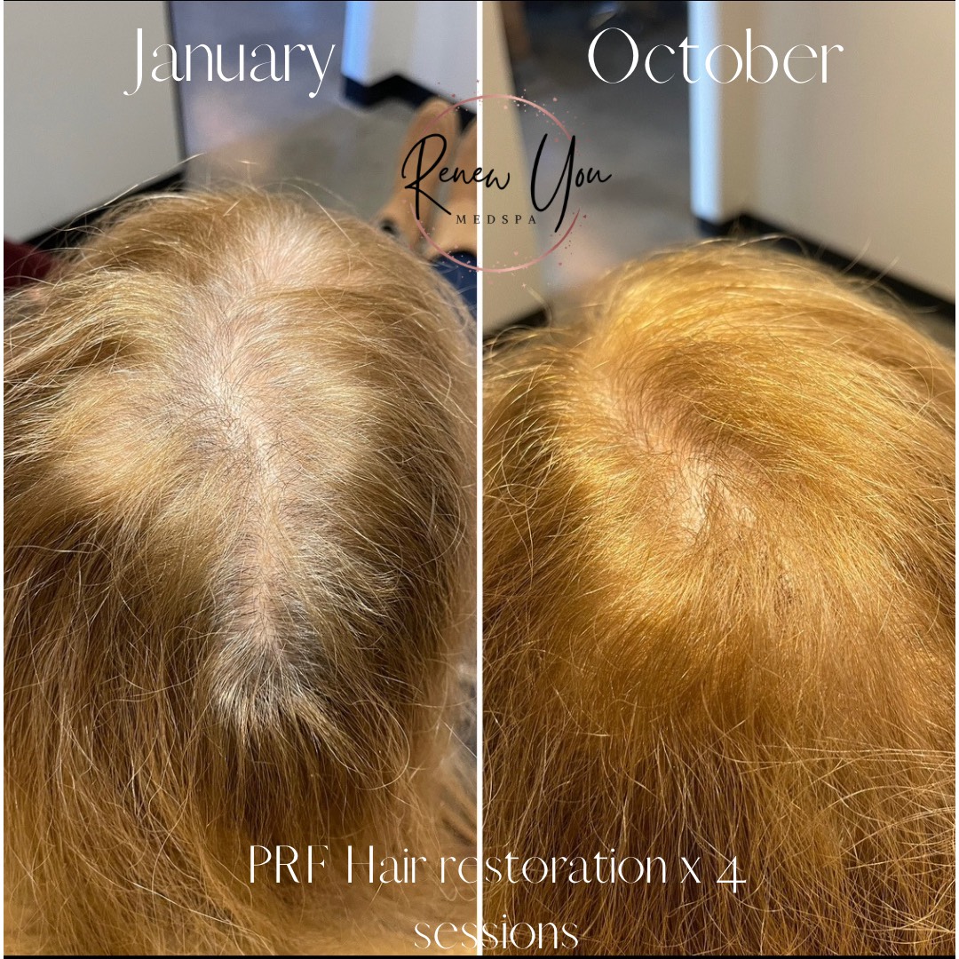 Before and After Image: PRP/PRF/PFR - back