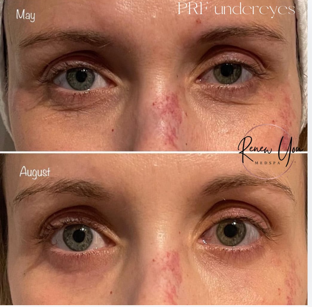 Before and After Image: PRP/PRF/PFR - front