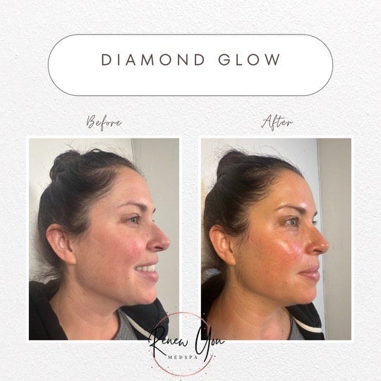 Before and After Image: Diamond Glow - right-front-oblique