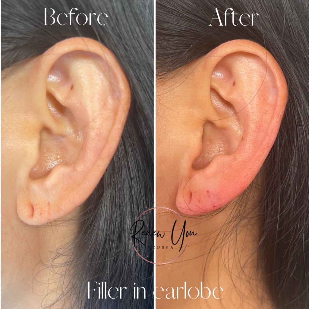 Before and After Image: Filler - left-side