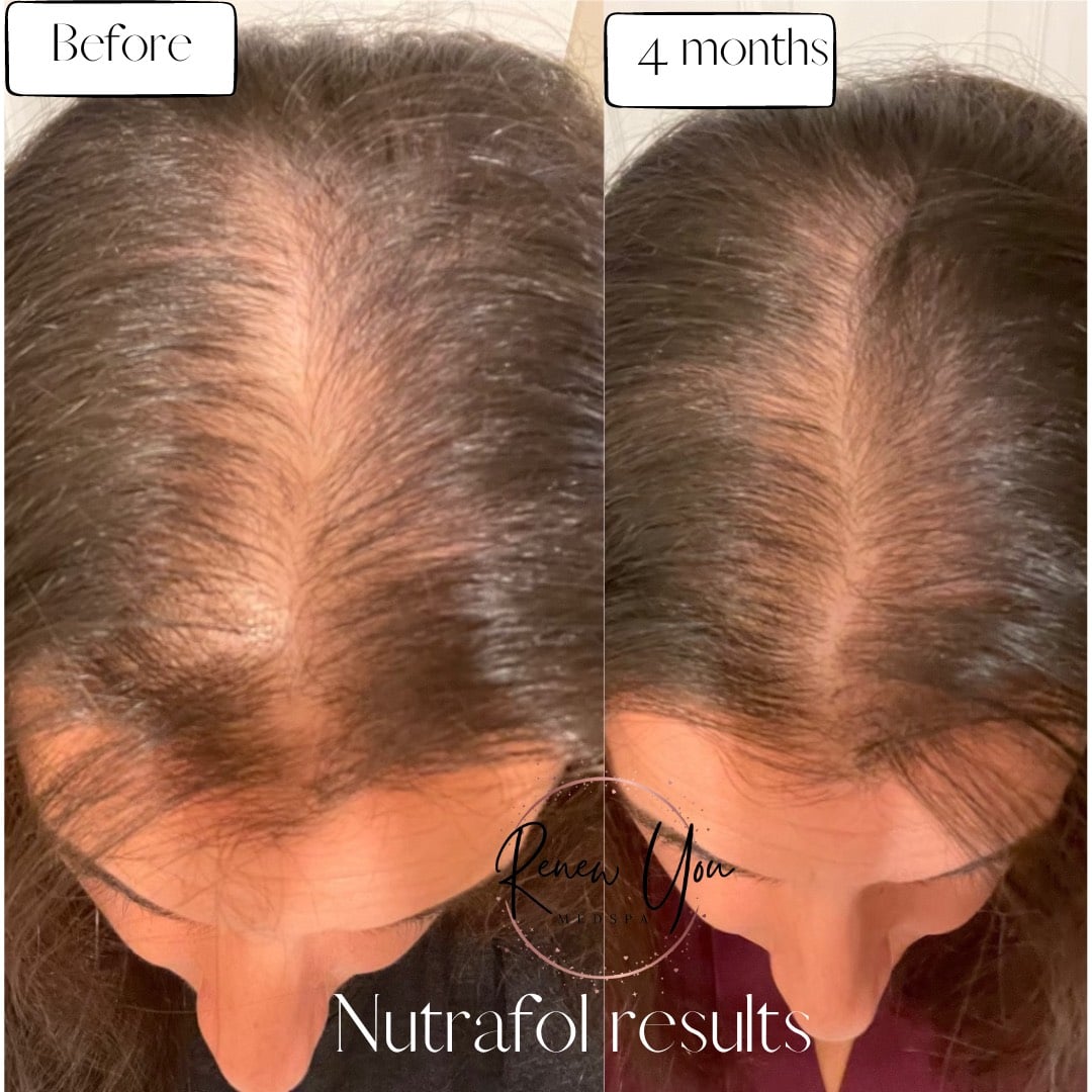 Before and After Image: Nutrafol - front