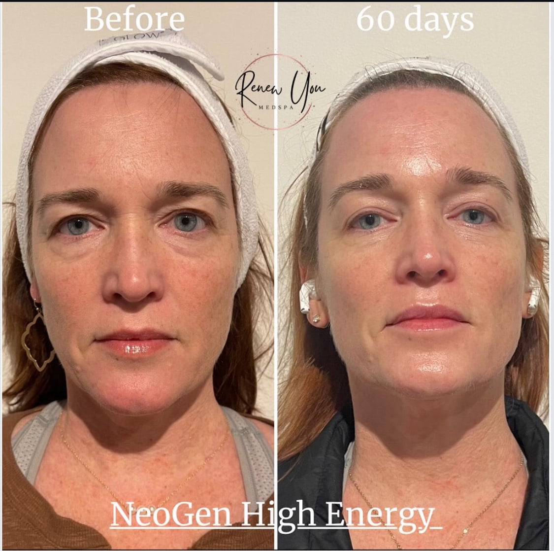 Before and After Image: NeoGen PSR - front