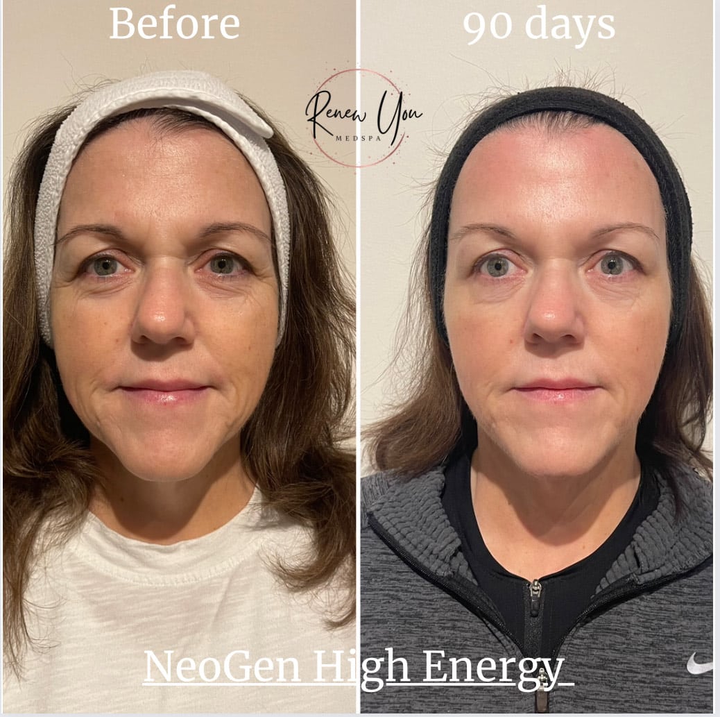 Before and After Image: NeoGen PSR - front