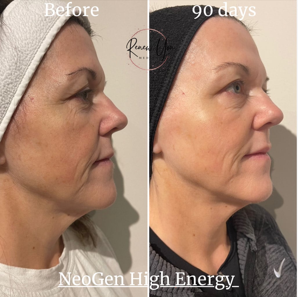 Before and After Image: NeoGen PSR - right-side