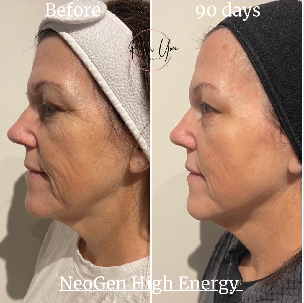 Before and After Image: NeoGen PSR - left-side