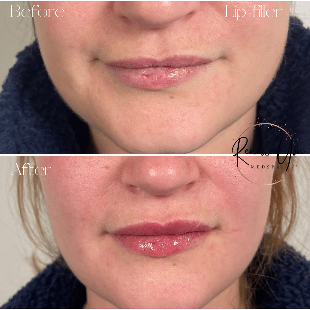Before and After Image: Lip Filler (Revanesse Lips) - front