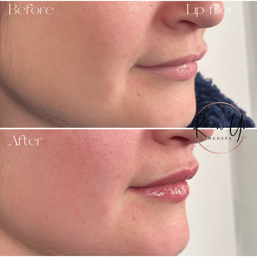 Before and After Image: Lip Filler (Revanesse Lips) - right-front-oblique