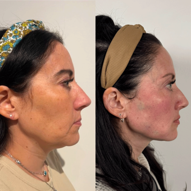 Regenerate your skin for long lasting youthful natural look with Radiesse!