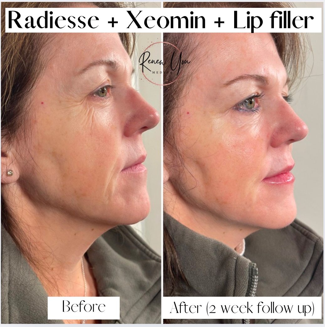 Before and After Image: Radiesse/Xeomin/Lip Filler - right-front-oblique